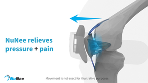 Patellar Joint Distraction Bracing; an innovative new therapy for treatment of Anterior Knee Pain